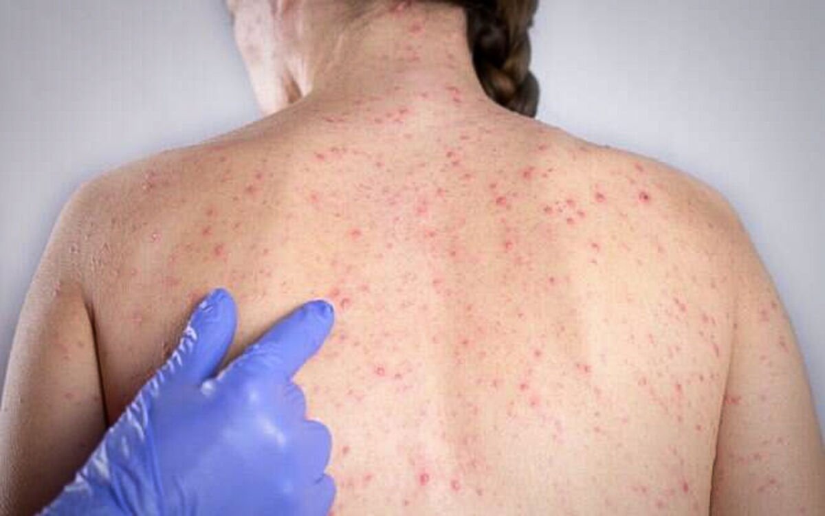 Sarampo avança em São Paulo com confirmação de novos casos e acende alerta de surto