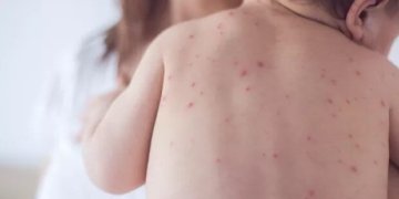 Sarampo exige alerta vacinal em São Paulo após confirmação de 23 casos no estado