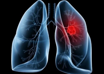 Adenocarcinoma pulmonar é o diagnóstico que levou o papa Leão XIV à mesa de cirurgia