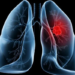 Adenocarcinoma pulmonar é o diagnóstico que levou o papa Leão XIV à mesa de cirurgia