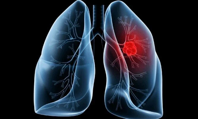 Adenocarcinoma pulmonar é o diagnóstico que levou o papa Leão XIV à mesa de cirurgia
