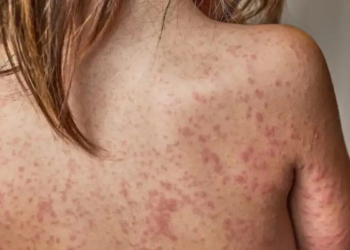 Brasil endurece vigilância sanitária contra o retorno do sarampo após surto nas Américas