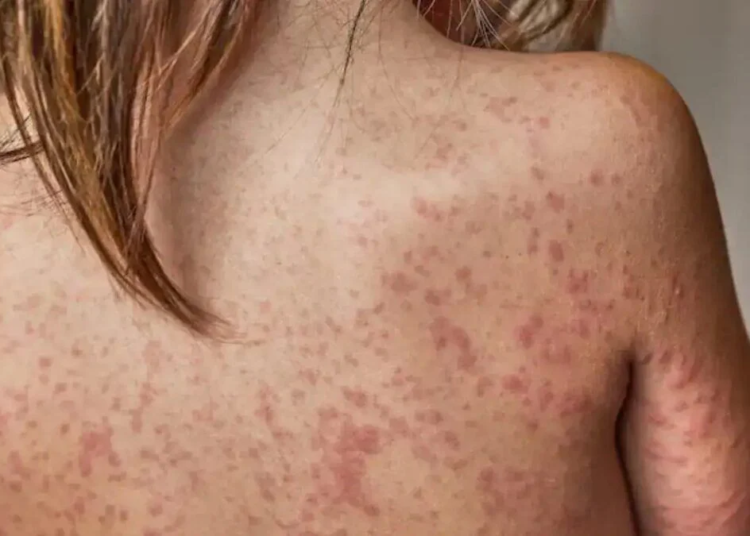 Brasil endurece vigilância sanitária contra o retorno do sarampo após surto nas Américas