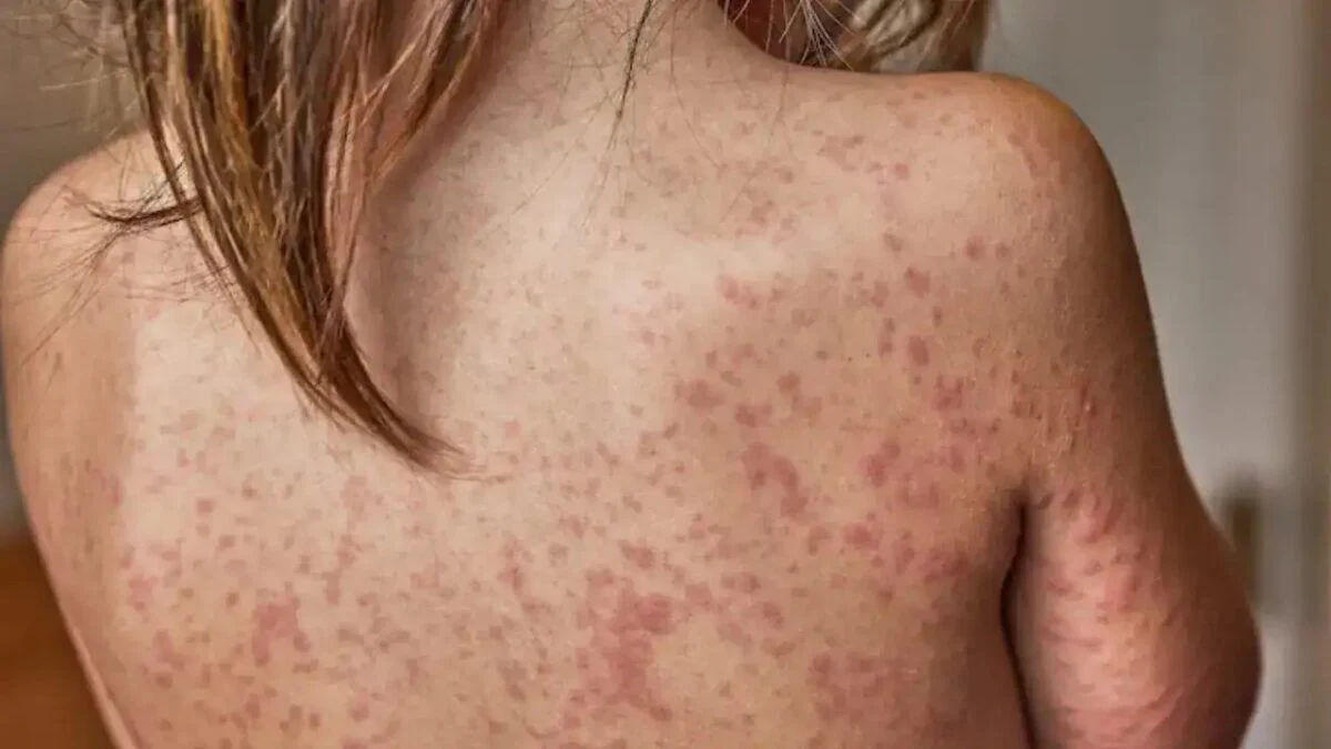 Brasil endurece vigilância sanitária contra o retorno do sarampo após surto nas Américas